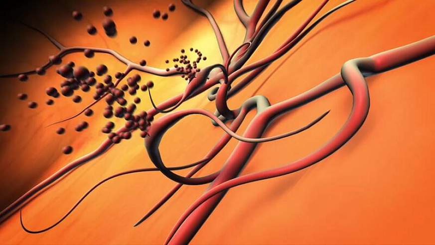 Illustration of ruptured blood vessels 