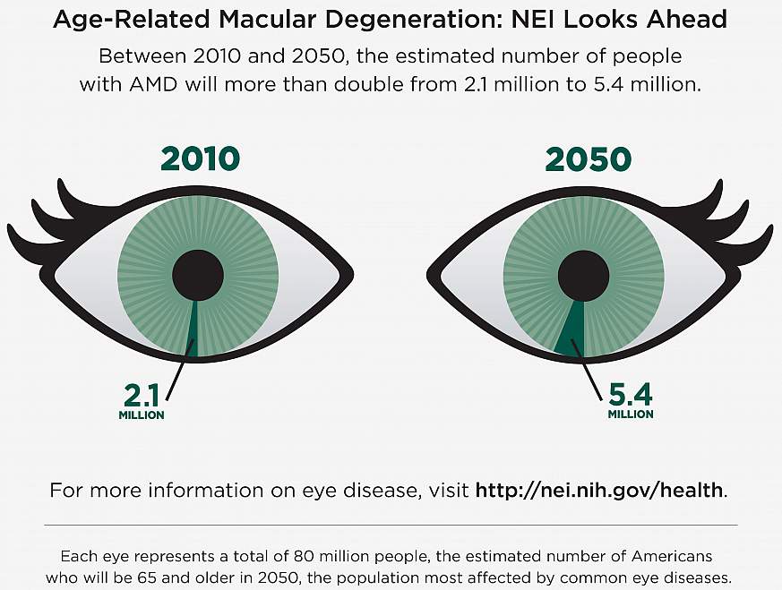 Age Related Macular Degeneration AMD