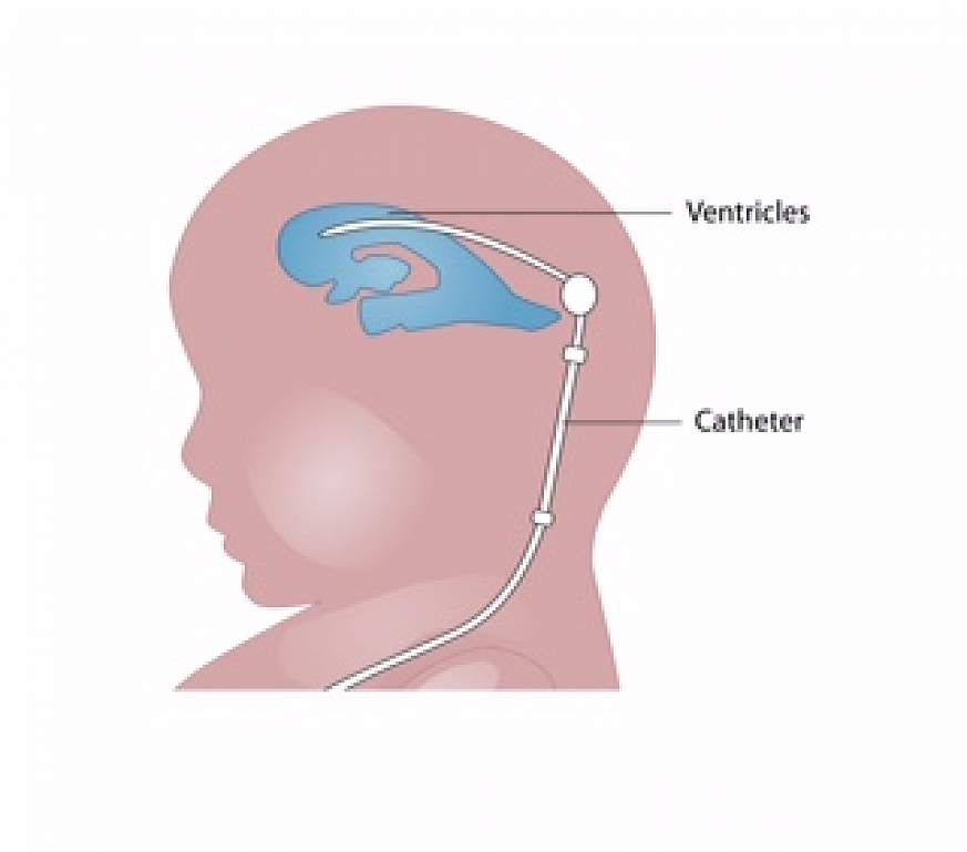Illustration of a brain shunt