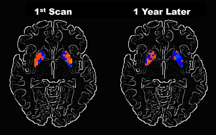 fMRI scans showing reduced activity in the brains of Parkinson's disease patients after a year