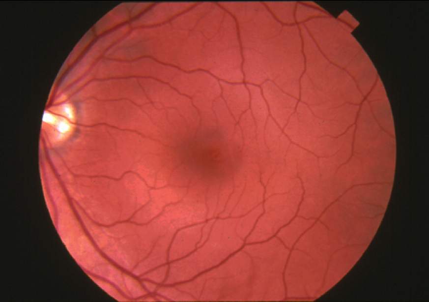 Normal Retina  Fundus photograph-normal retina.