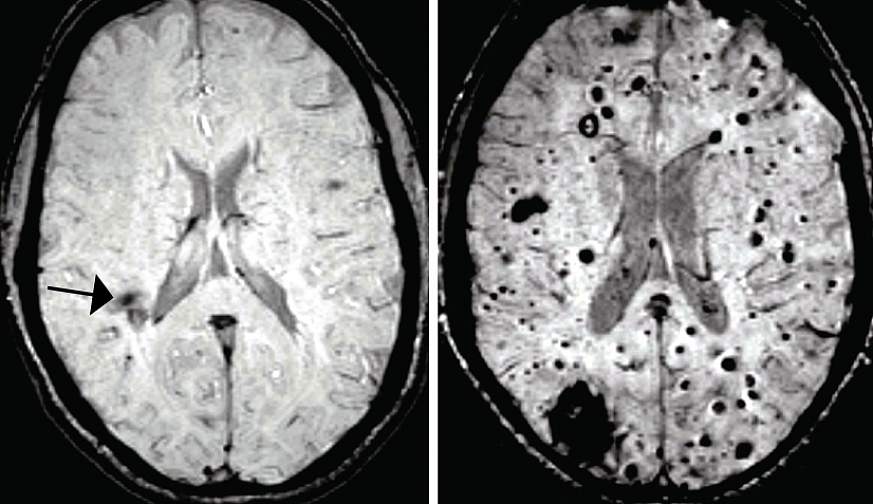 MRI scans of two brains