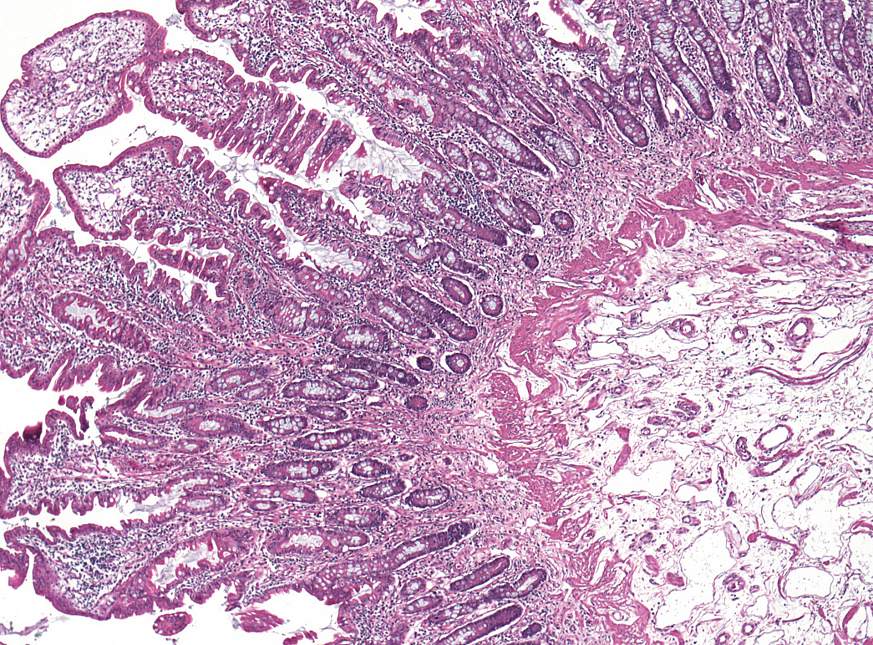 Image of gut tissue in CHAPLE disease