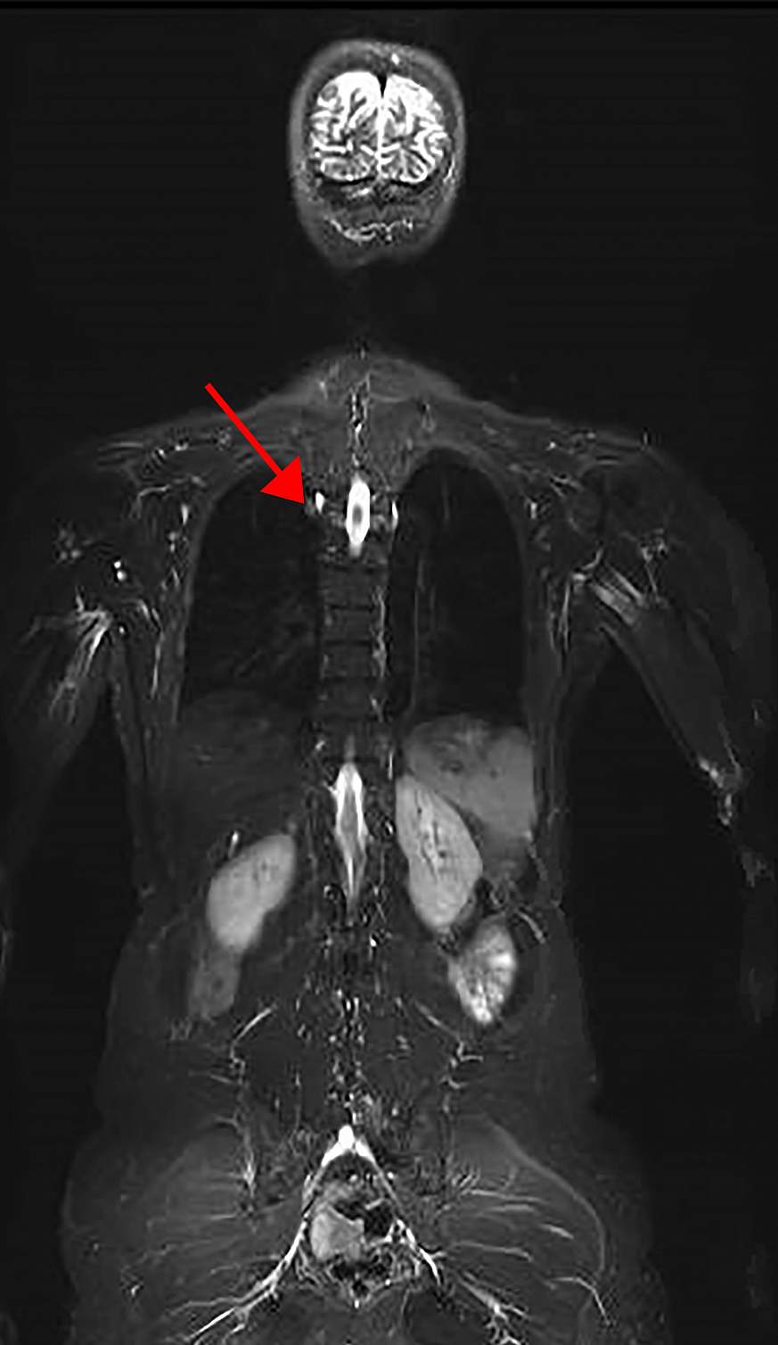 whole body MRI of an LFS patient