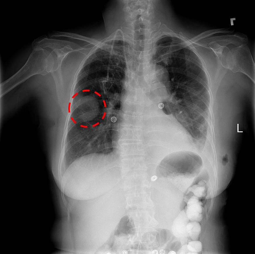 normal chest xray labeled