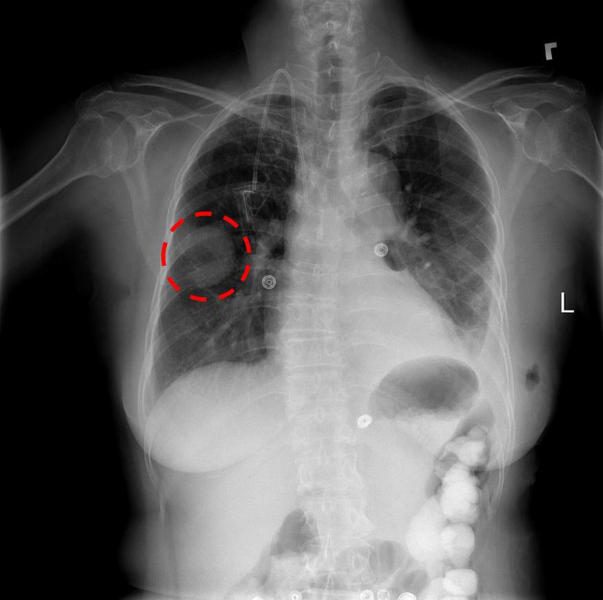 Изображение рентгена грудной клетки