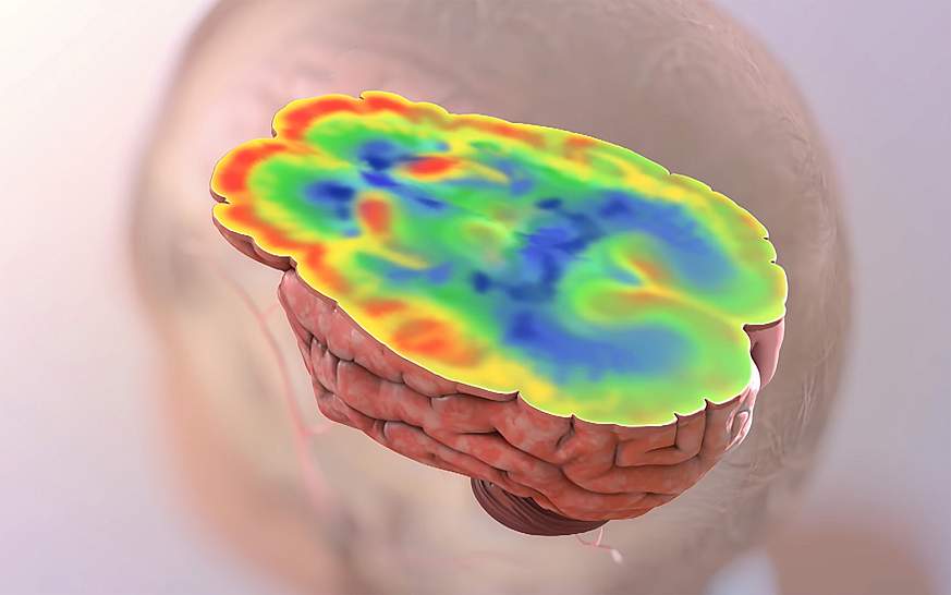 Illustration of elevated glucose levels in the brain.