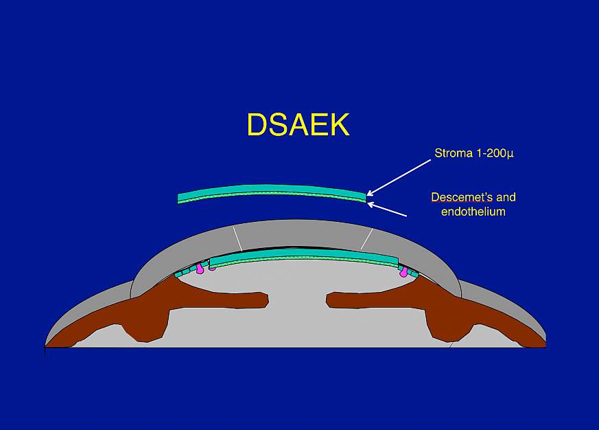 illustration of corneal transplantation