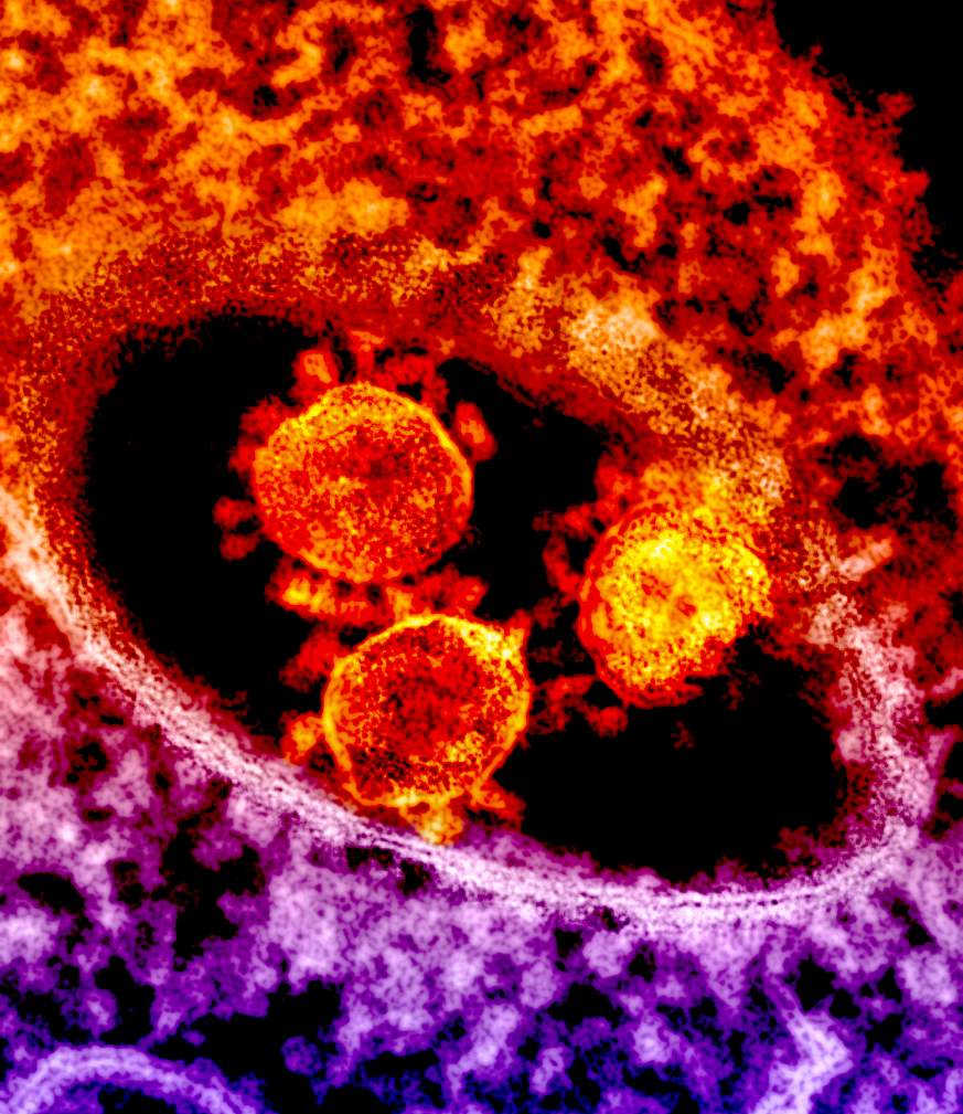 Microscopic image of MERS coronavirus particles.