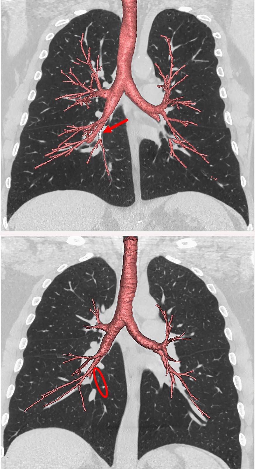 Images of the lungs highlighting the airway branches