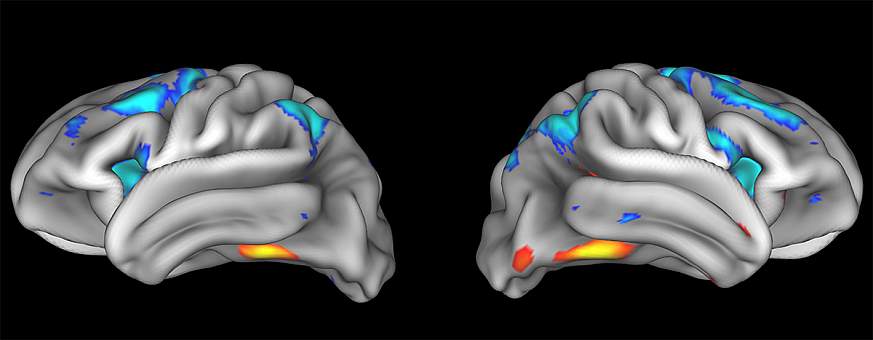 Two images of the human brain.