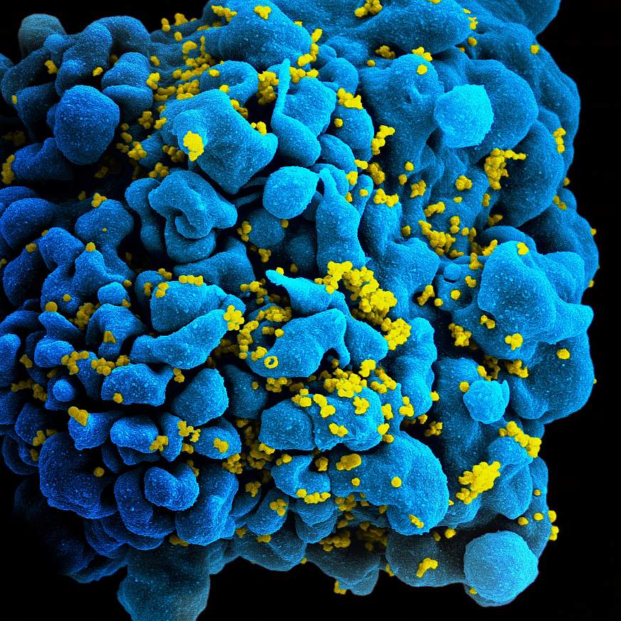 Microscopic image of an HIV-infected T cell