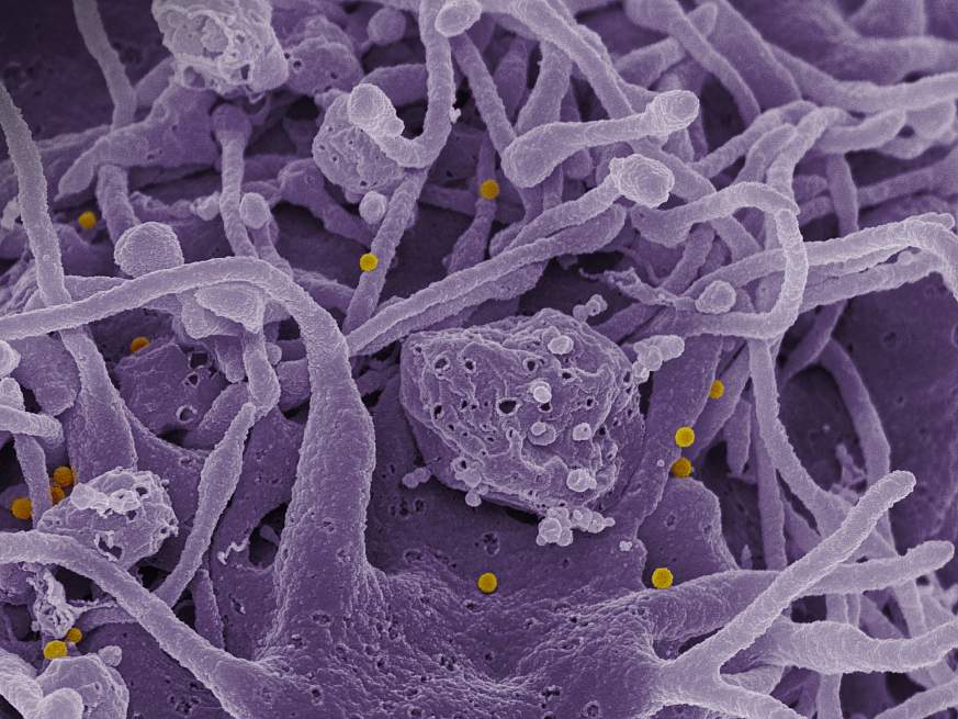 Scanning electron micrograph of CCHF viral particles