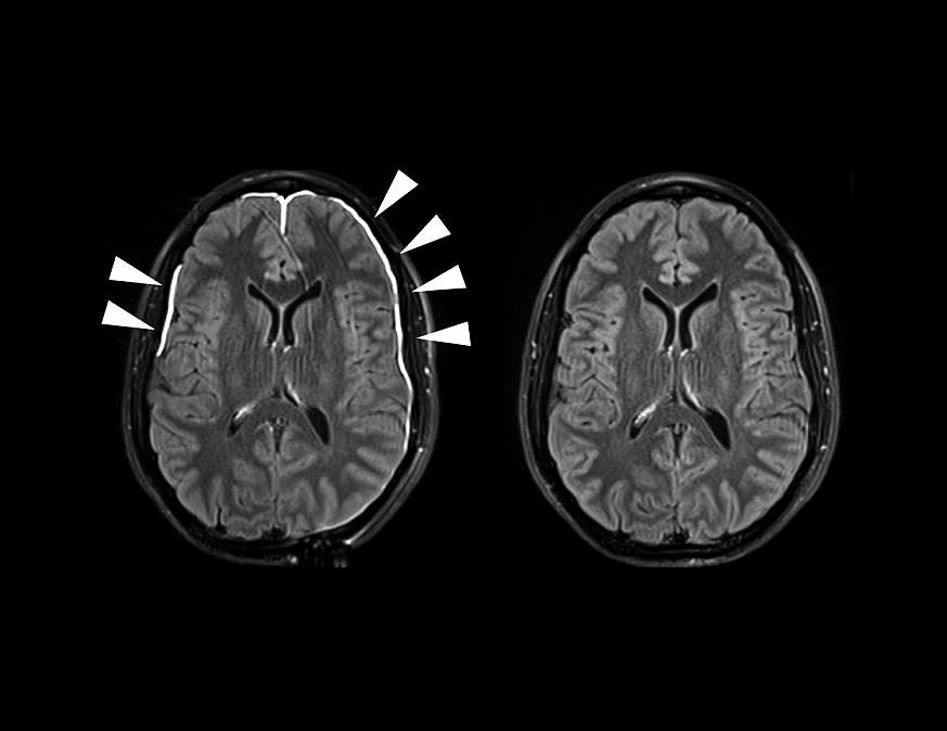 Images of brain scans one and 35 days after head injury