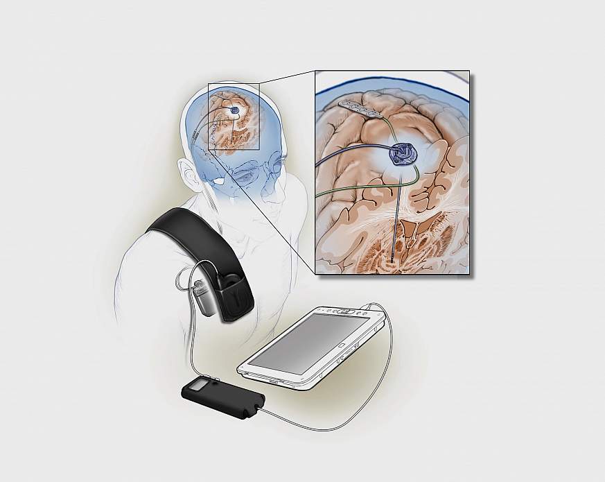 Image of Implanted deep brain stimulation device 