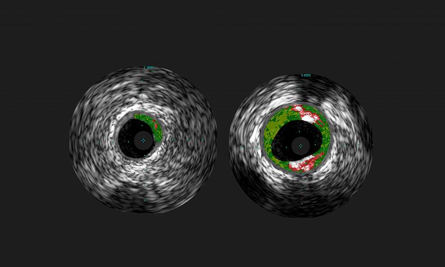 Scan of cross-sectional ultrasound images of coronary arteries 
