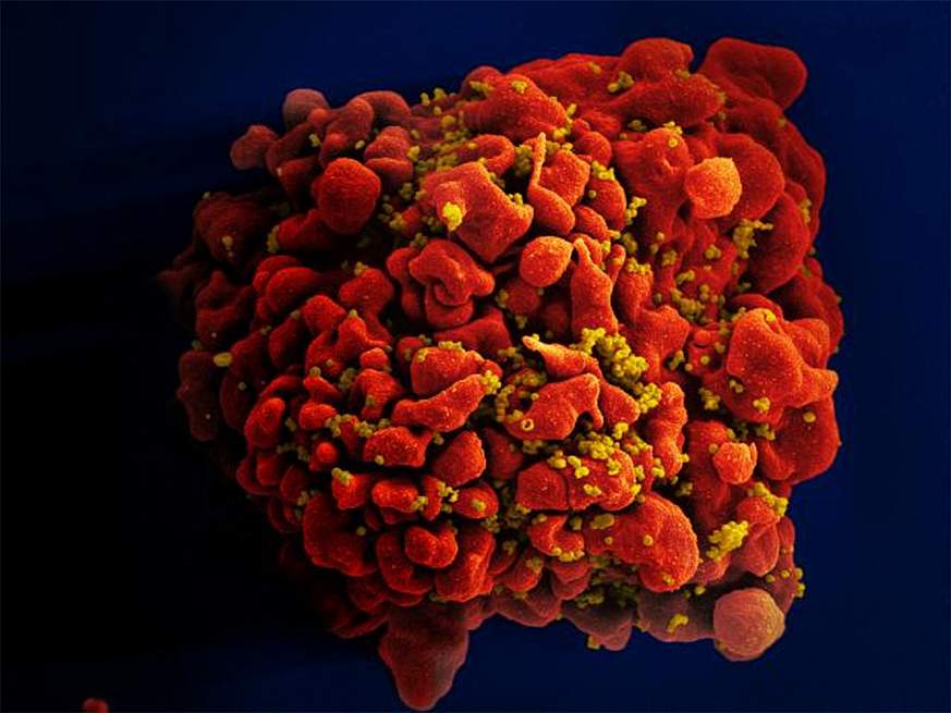 Scanning electron micrograph of an HIV-infected H9 T cell. 