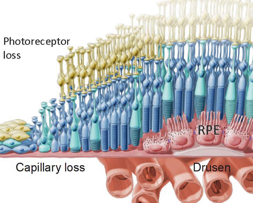 Dry AMD is accompanied by drusen deposits and the degeneration of the retinal pigment epithelium (RPE) and subsequent loss of the light-sensing photoreceptors and the capillary network called the choriocapillaris.