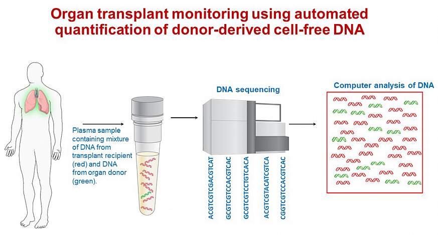 Illustration of blood test for early detection of severe lung-transplant rejection.