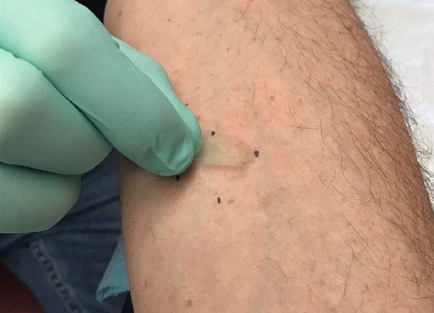 A gloved hand of a researcher peels a small, clear tape strip up from a bare arm.