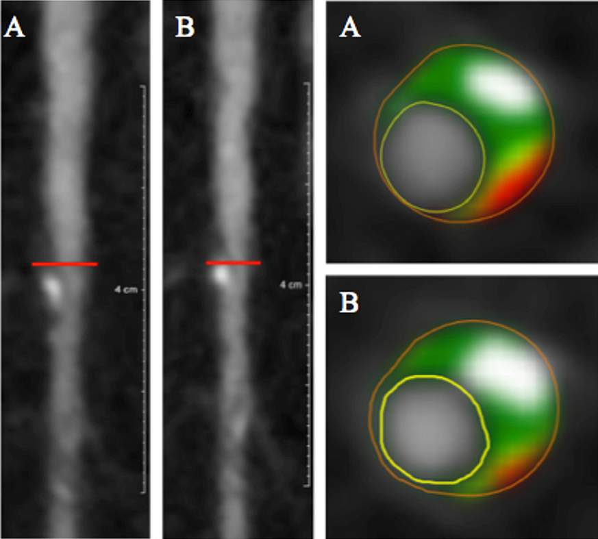 Artery before and after treatment with biologic therapy. 