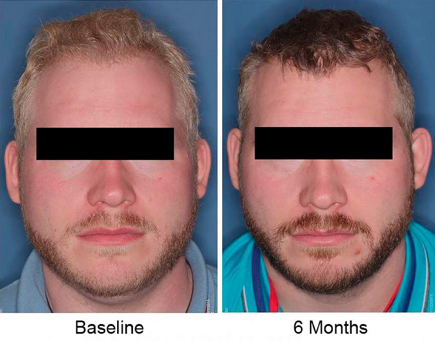 Photos of study participant with pale hair, left, and darker hair, right.