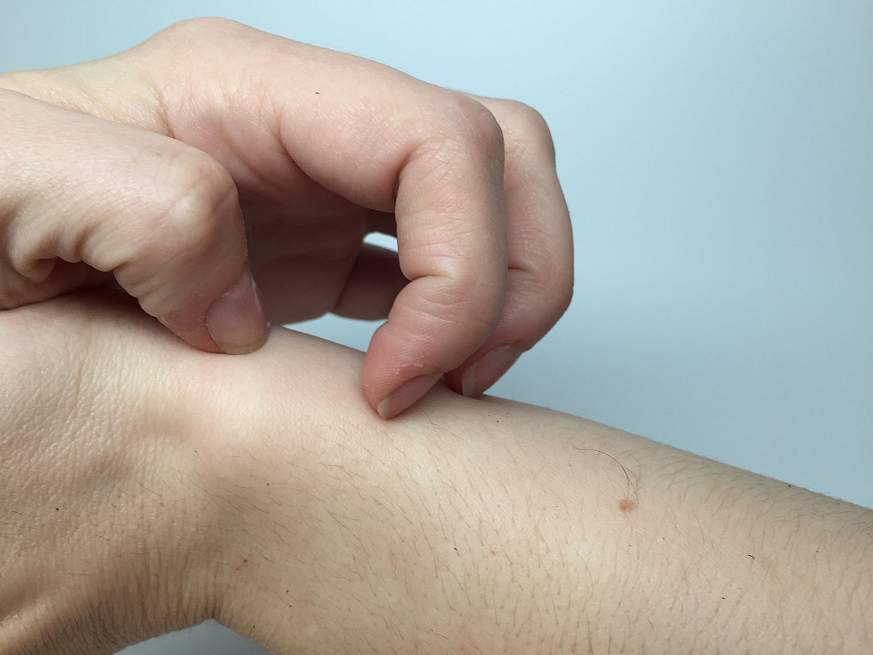 Image of a woman’s hand scratching her arm