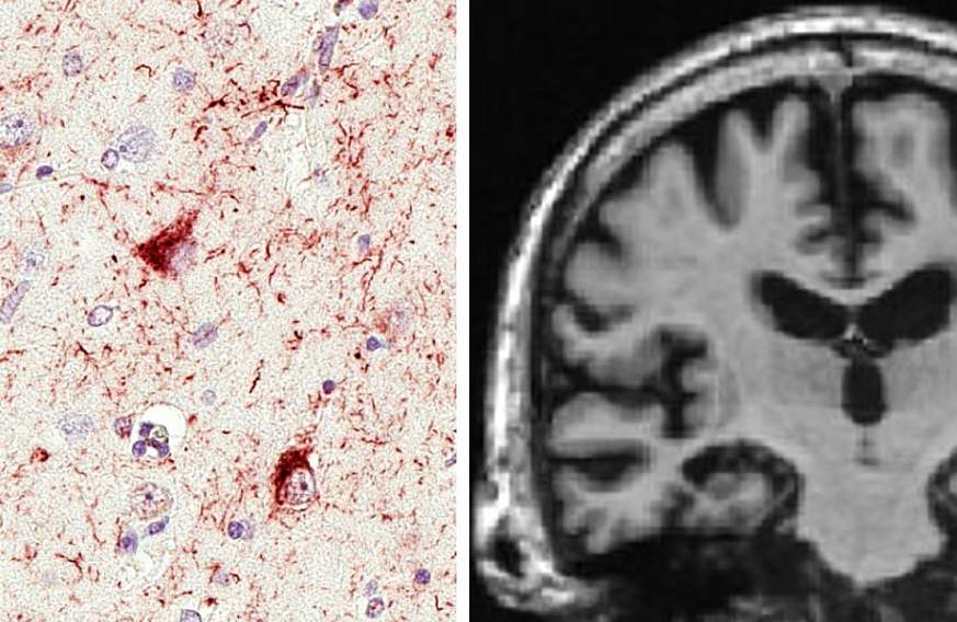 Microscope and MRI image of Limbic-predominant Age-related TDP-43 Encephalopathy, or LATE