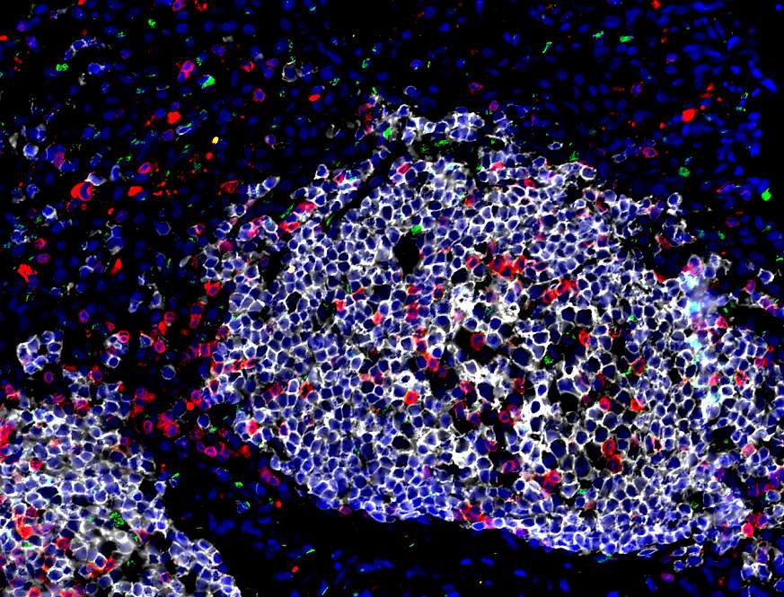 Mycobacterium Tuberculosis Granuloma