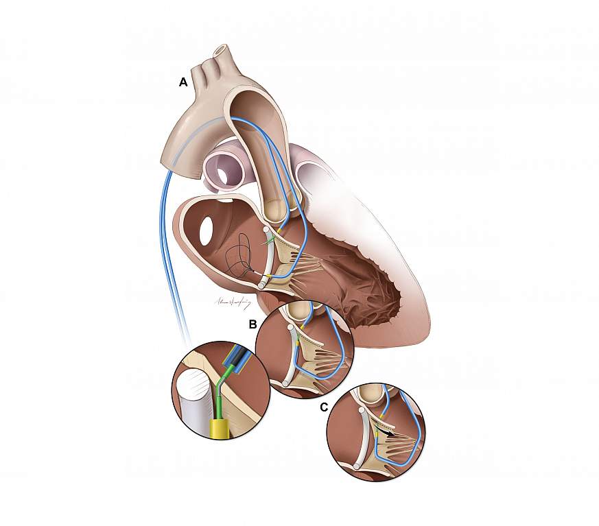 Illustration of the LAMPOON procedure.