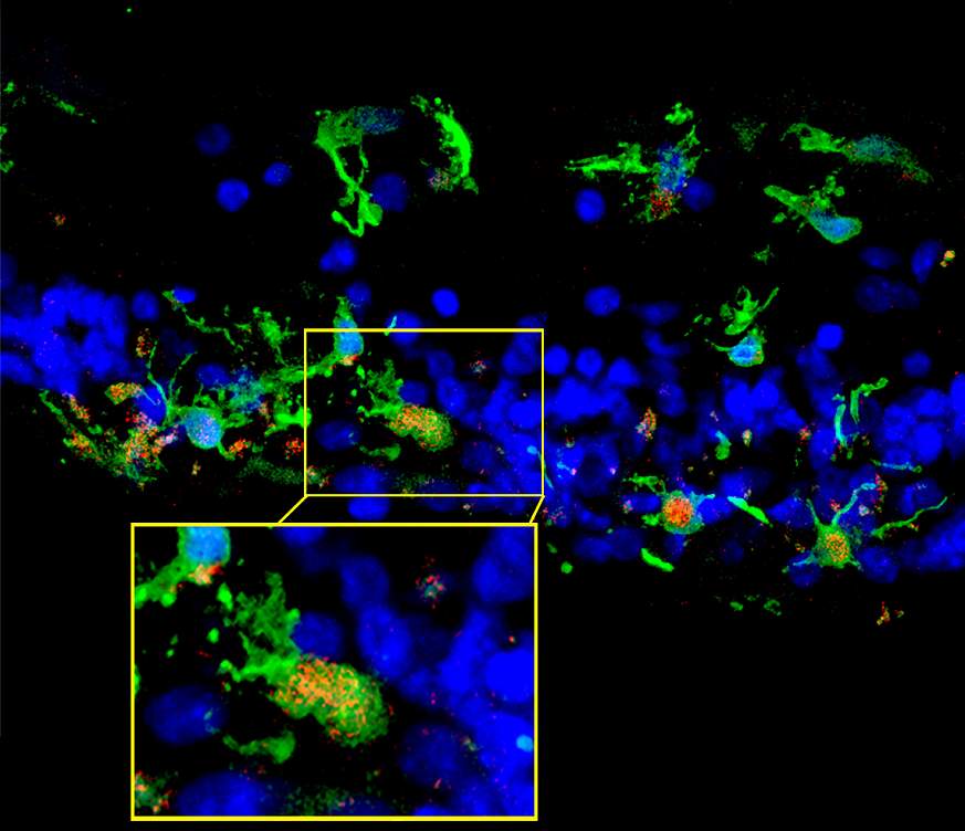 Retinal sections from a patient with retinitis pigmentosa