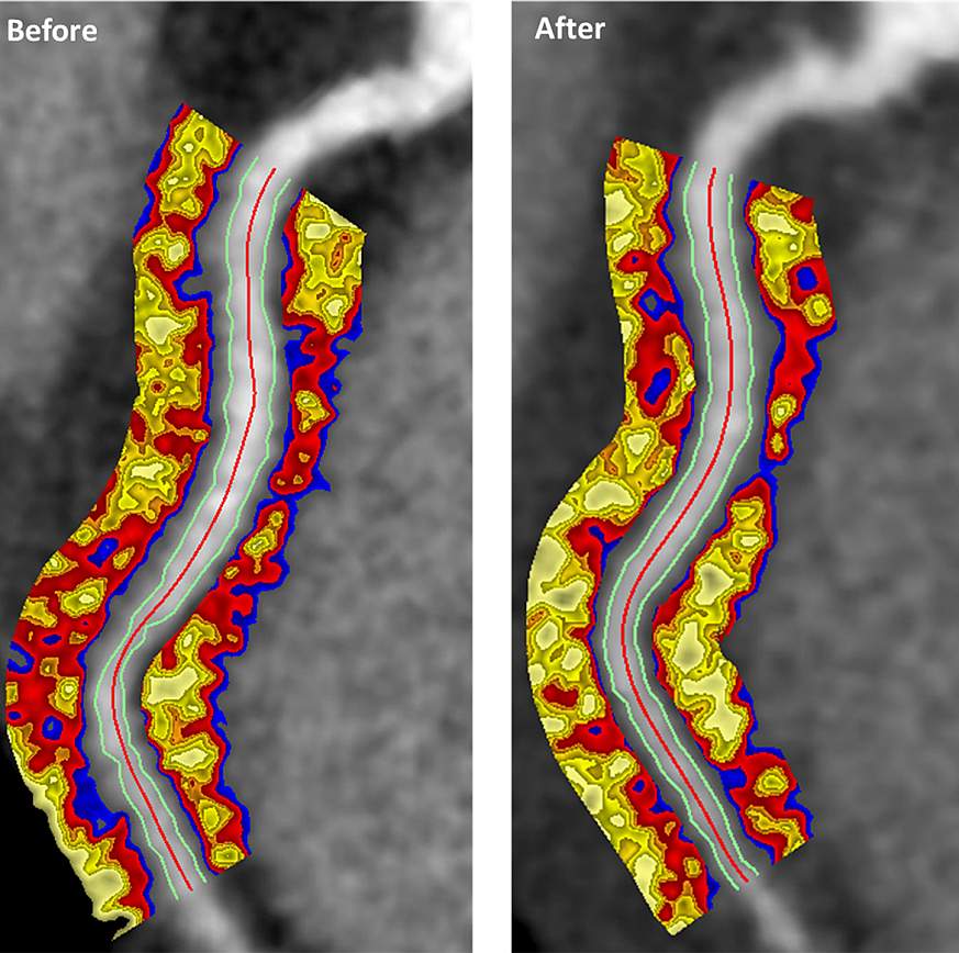 Image of a coronary CT scan