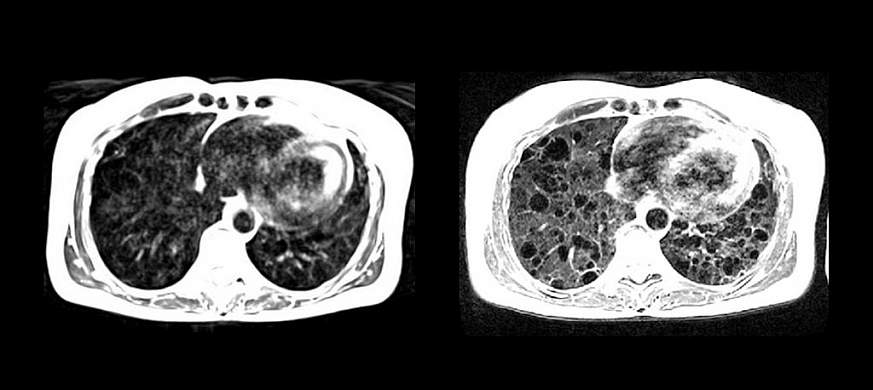 NIH researchers develop MRI with lower magnetic field for cardiac and lung imaging | National of Health (NIH)