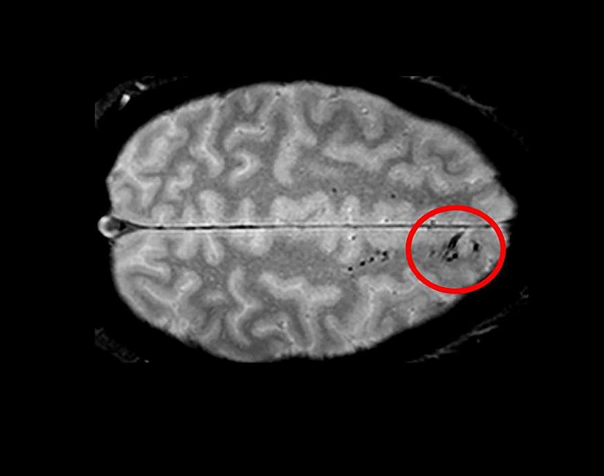 Brain scan showing microbleeds