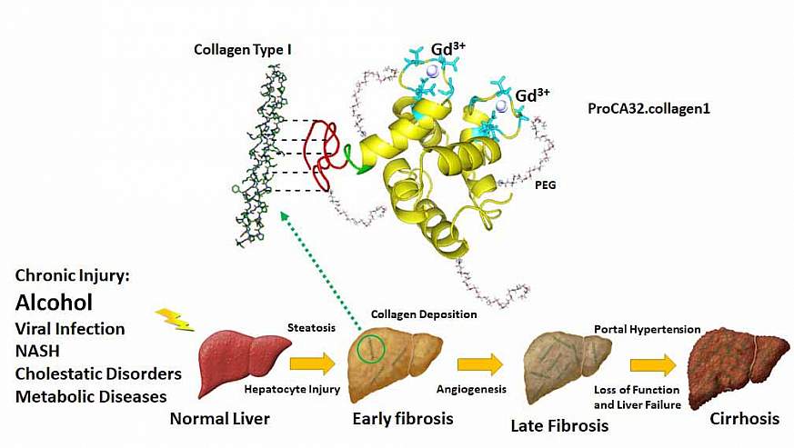 Illustration of early stage fibrosis detection