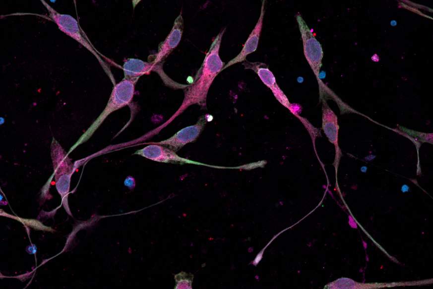 Micrograph of brain cancer cells grown in the laboratory. 