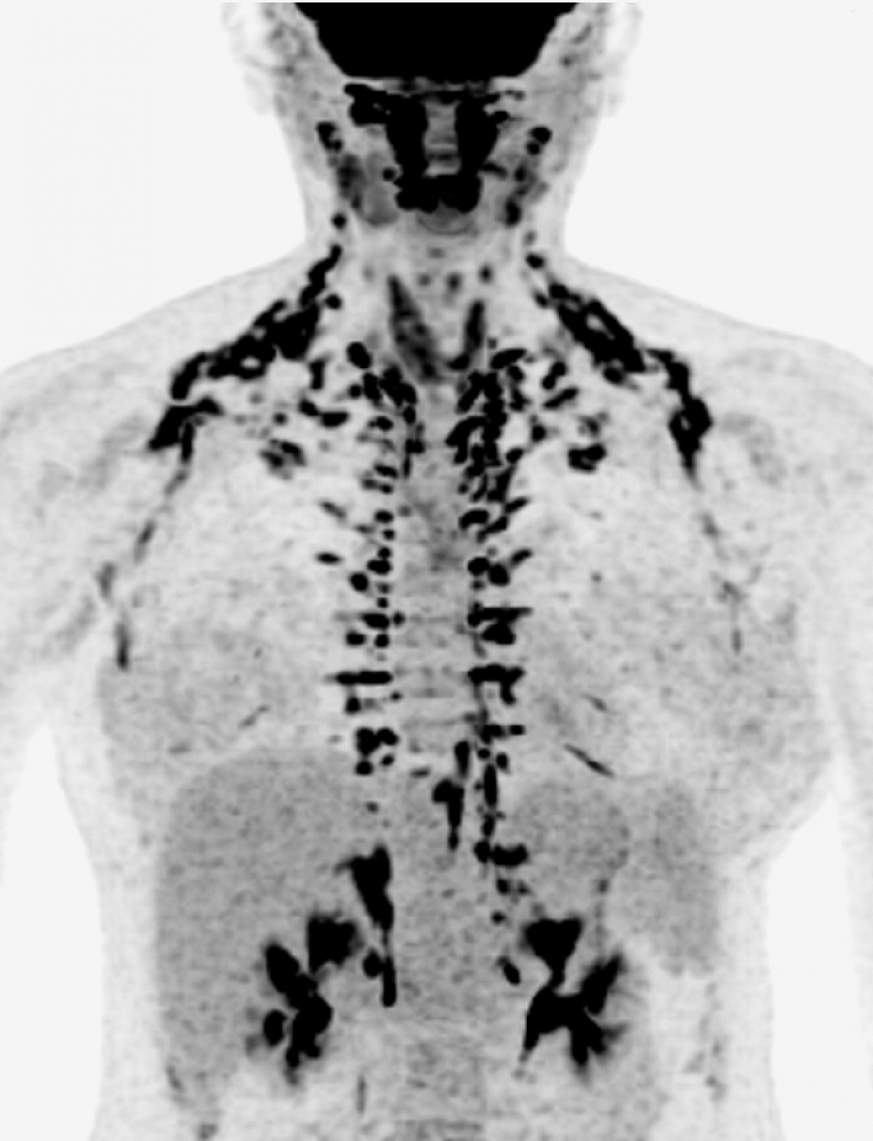 Scan showing human brown fat