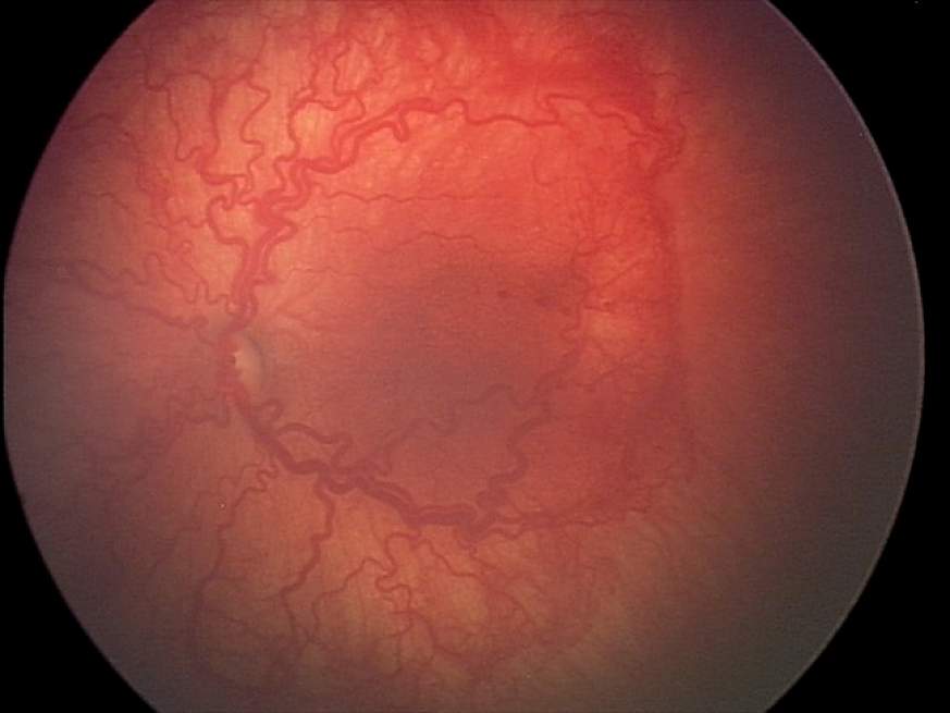 Image of the interior of the eyeImage of the interior of the eye