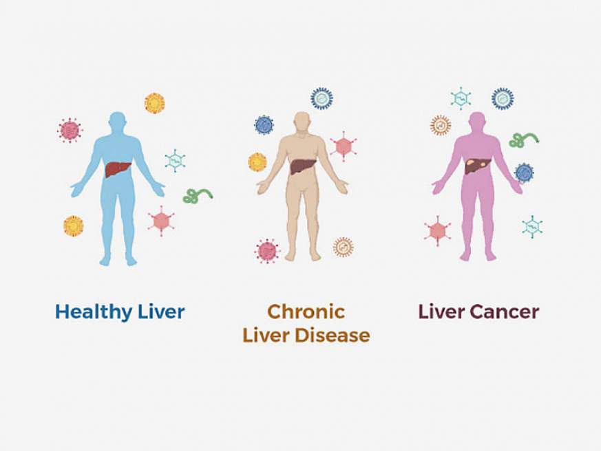 Illustration of different types of liver disesae