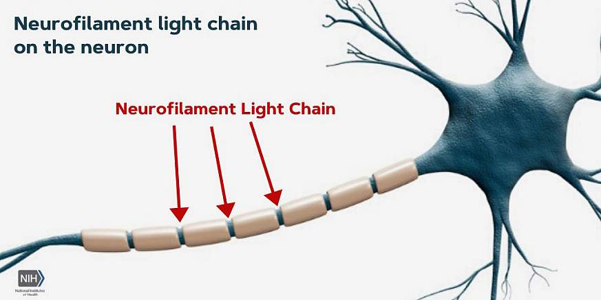 Illustration of neurofilament light chain