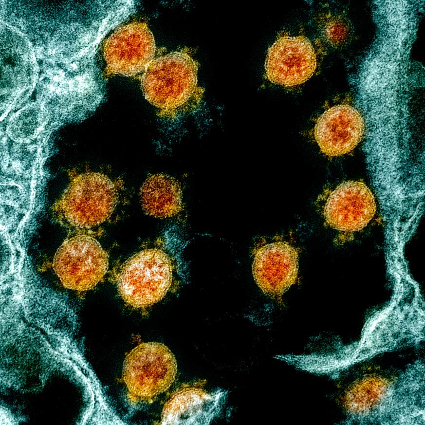 A transmission electron micrograph showing SARS-CoV-2 virus particles