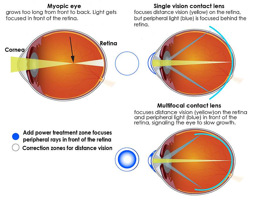 Lens of the Eye - All About Vision