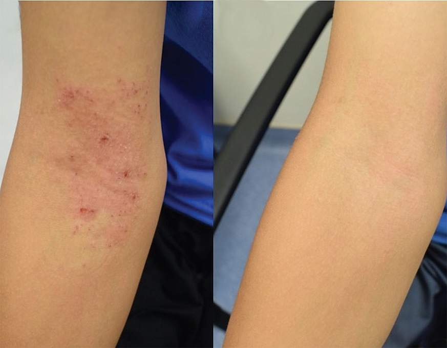 Images showing arm before and after treatment