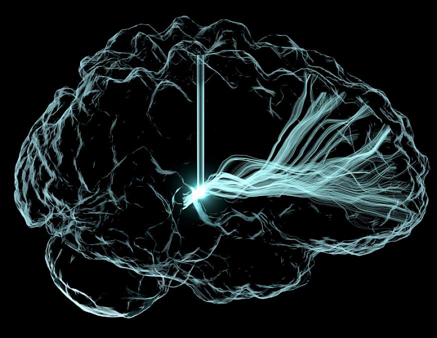 Image showing electrical excitation by deep brain stimulation in human brain