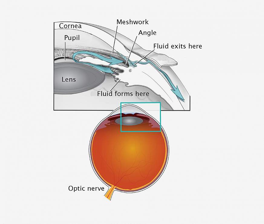 Illustration of cataract surgery