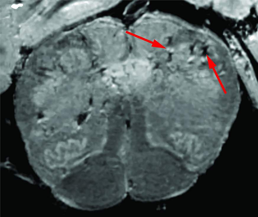 Scan of deceased COVID-19 patient’s brain