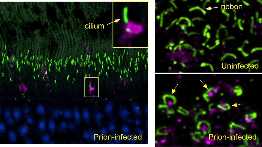 (left panel) Early in prion infection, a prion protein aggregate (magenta) blocks the entrance to a cilium (green) in a retinal photoreceptor. (lower right) In prion-infected retina, prion protein (magenta) accumulates under the horseshoe-shaped ribbon sy