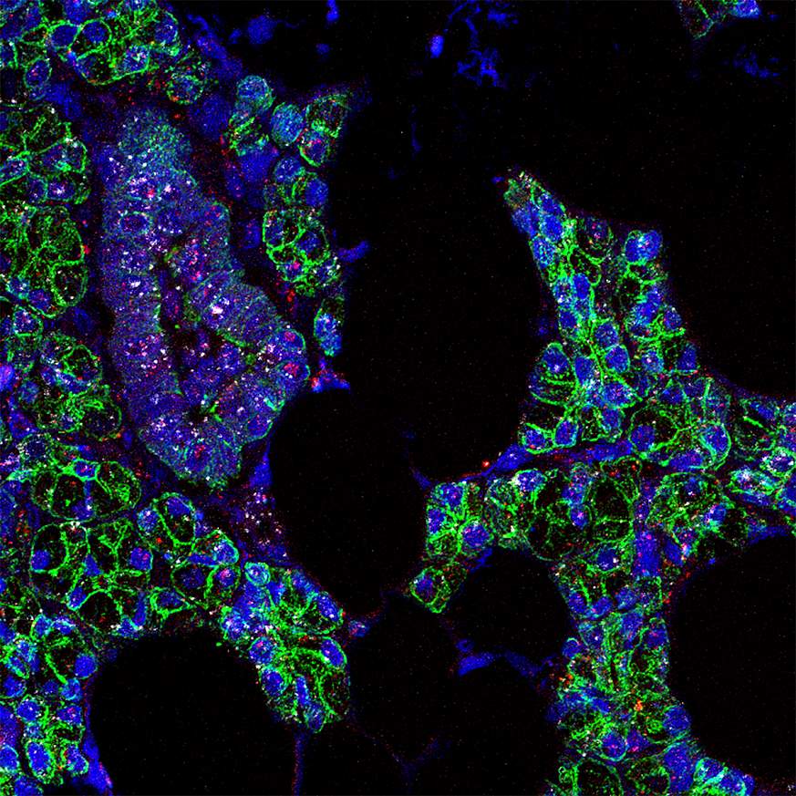 Fluorescent microscopy image of RNA for SARS-CoV-2 and ACE2 receptor in human salivary gland cells