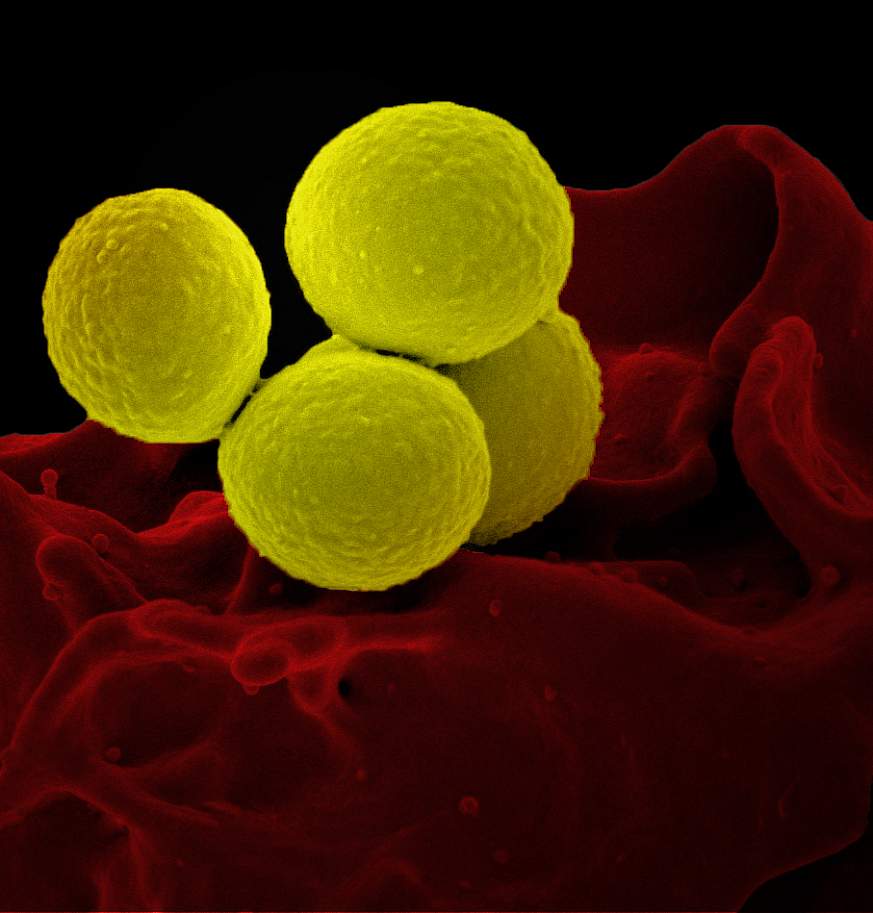 Trial of existing antibiotic for treating Staphylococcus aureus bacteremia  begins