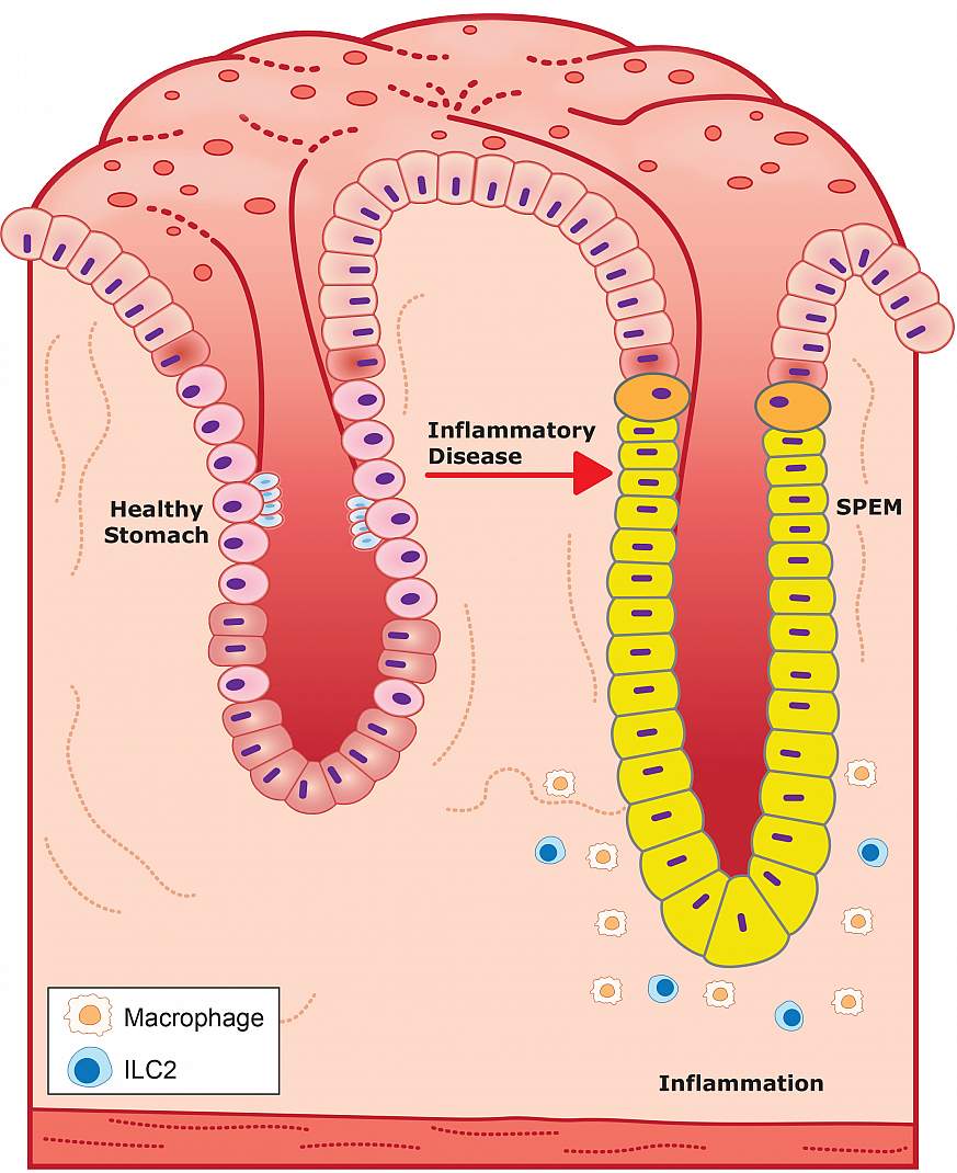 Illustration of healthy and diseased stomach glands